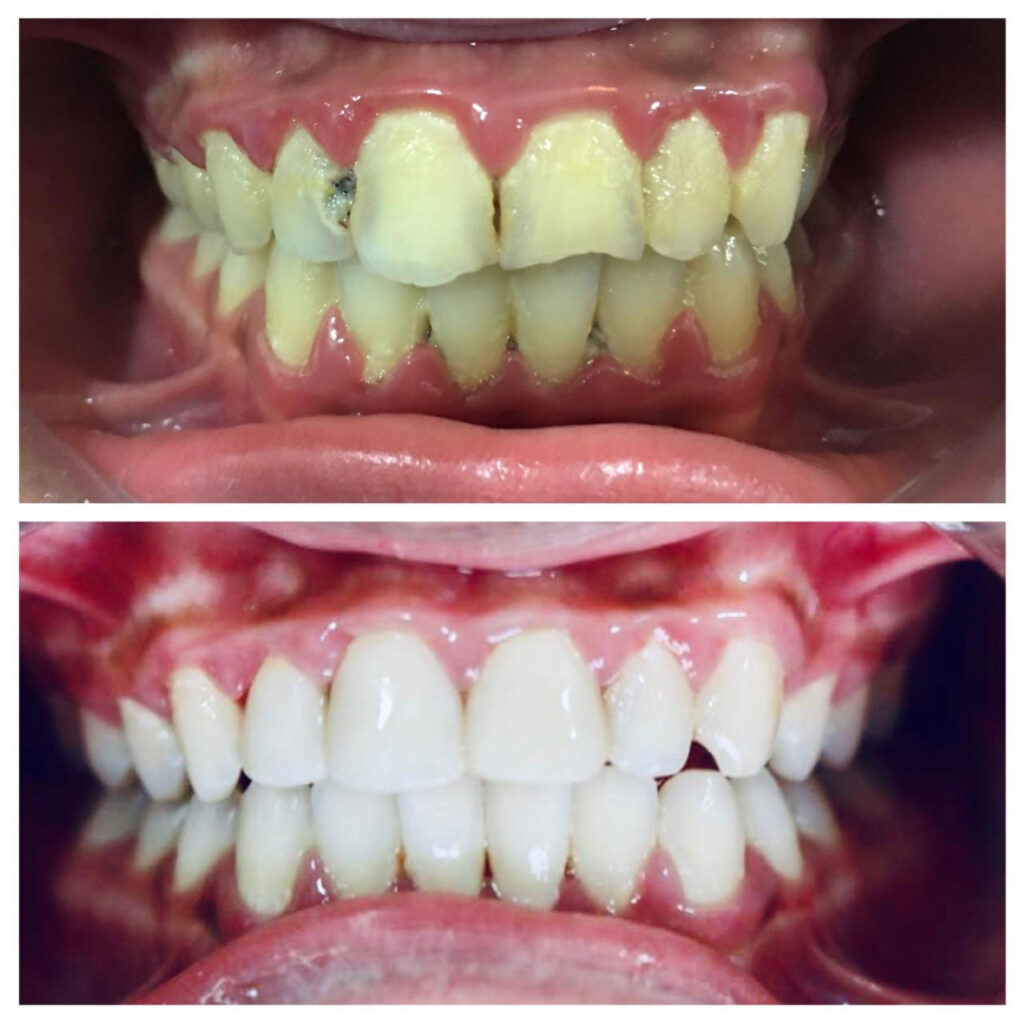 Clean, bleaching and tooth colored fillings